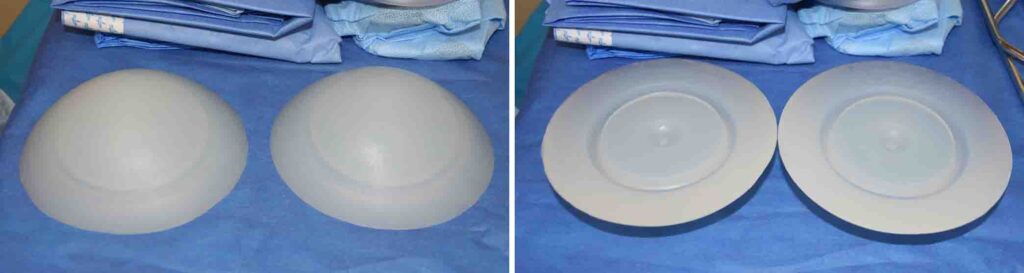 gluteoplastica-chirurgiaestetica-giuseppe scalera Gluteoplastica - Prof. Giusepe Scalera