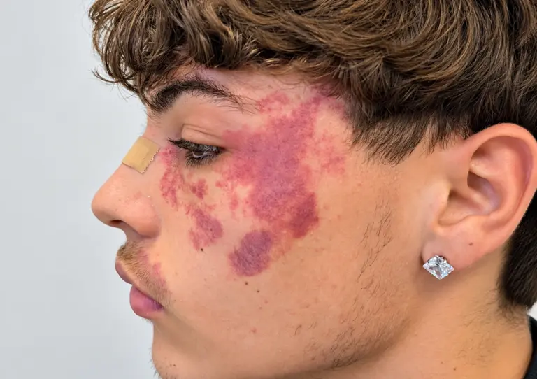 Angioma sul viso prima del trattamento