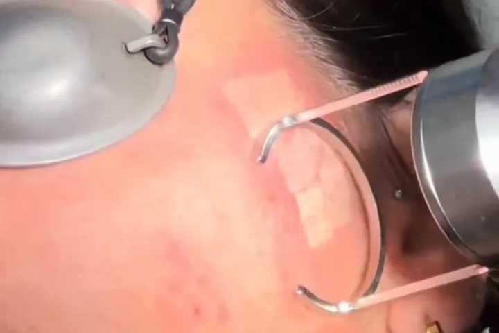 Trattamento laser CO2 frazionato delle cicatrici da acne, anteprima video 2