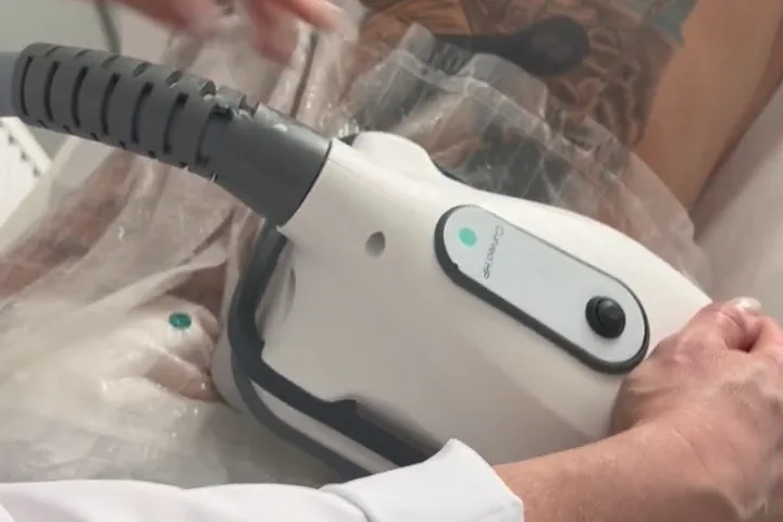 Applicazione del manipolo CoolTech Define per la criolipolisi, anteprima video 1