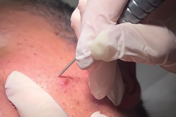 Rimozione laser di un fibroma cutaneo, anteprima video 1