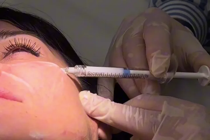Iniezione di filler nella zona della guancia, anteprima video 1