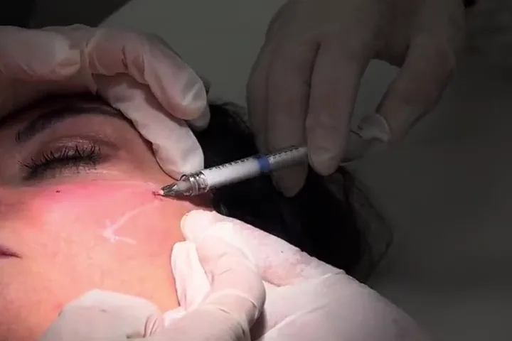Trattamento filler guance con siringa sullo zigomo, anteprima video 2