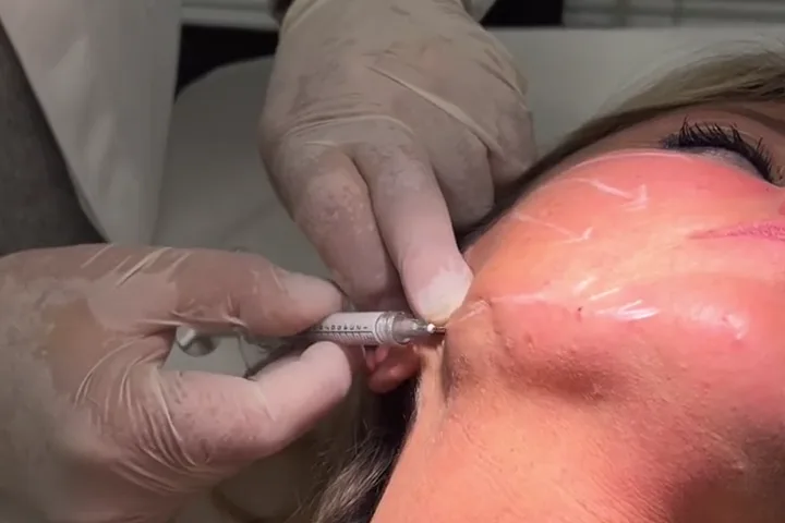 Iniezione di filler nella zona della mandibola, anteprima video 1