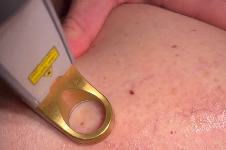 Trattamento laser delle lesioni vascolari