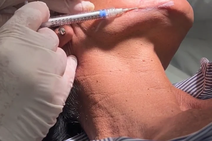Rimodellamento mandibolare: area trattata
