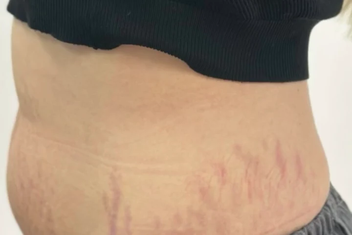 Trattamento di ringiovanimento cutaneo: anteprima video